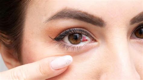 hot or cold compress for broken blood vessel in eye